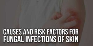 Causes-And-Risk-Factors-For-Fungal-Infections-Of-Skin